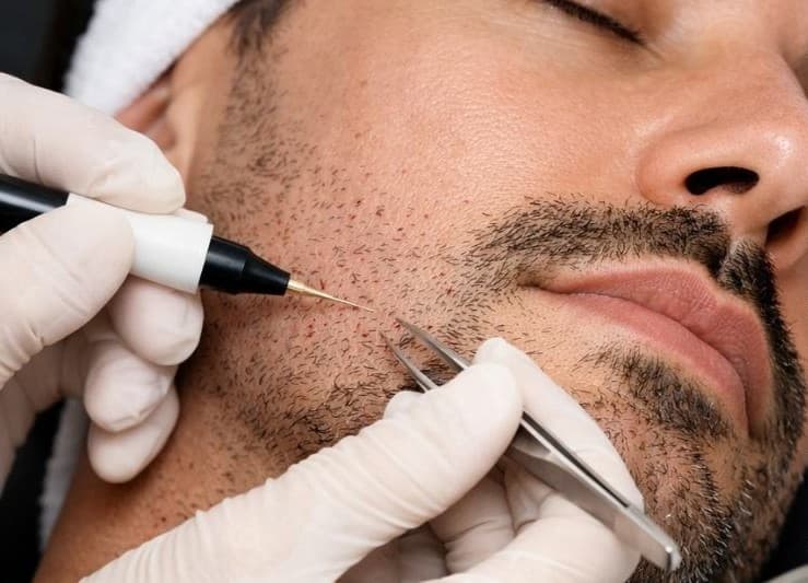 Elektroepilation
